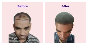 Hair transplant